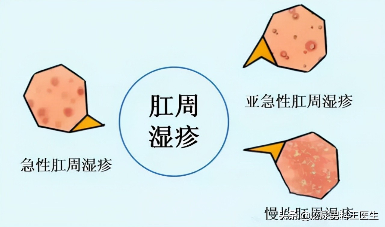 肛门瘙痒潮湿有分泌物怎么治疗,肛门潮湿还痒是什么症状