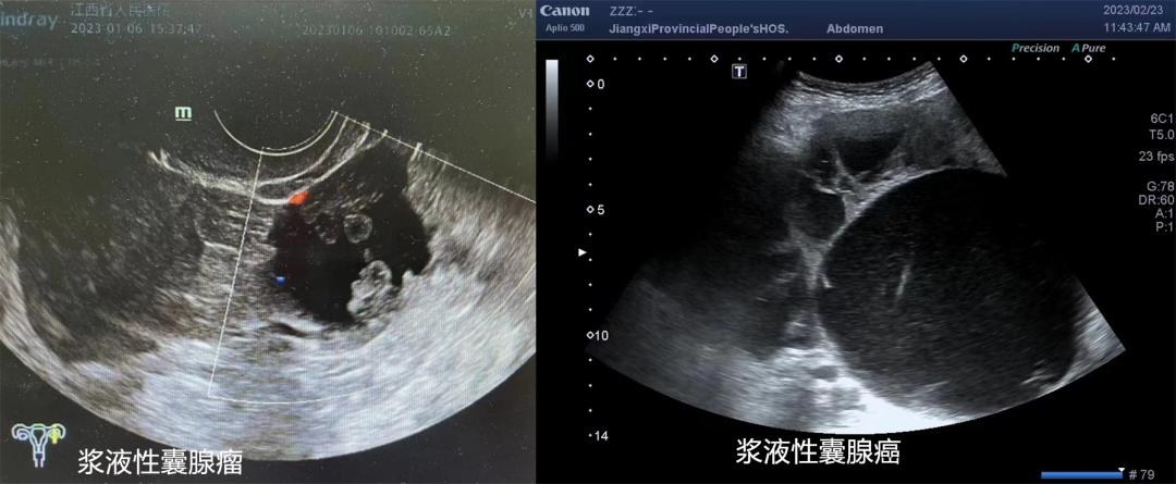 仁医科普|卵巢囊肿是什么？该如何处理？