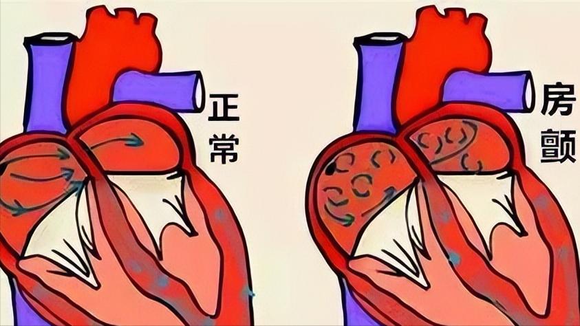 绝经3年又来例假是癌吗,绝经3年了还会排卵来例假吗