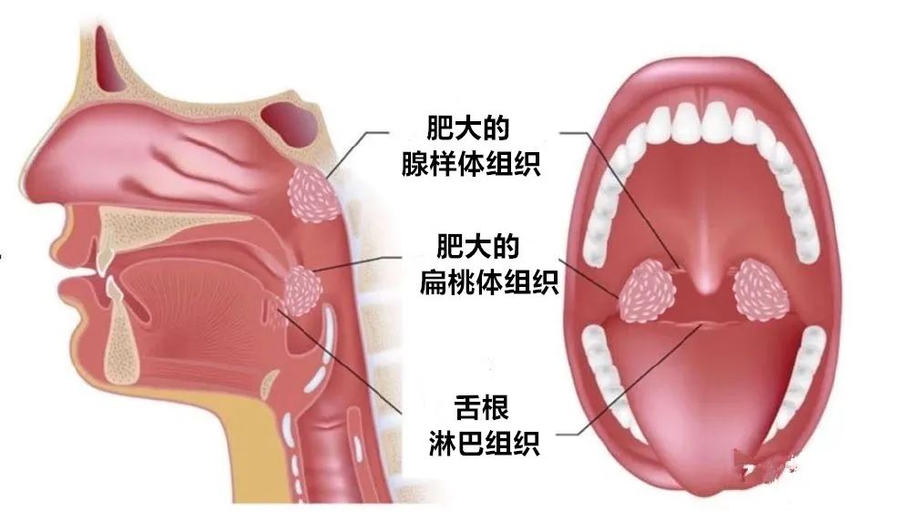 腺样体肥大造成嘴唇变厚会变丑吗,用嘴呼吸变丑还是腺样体肥大变丑