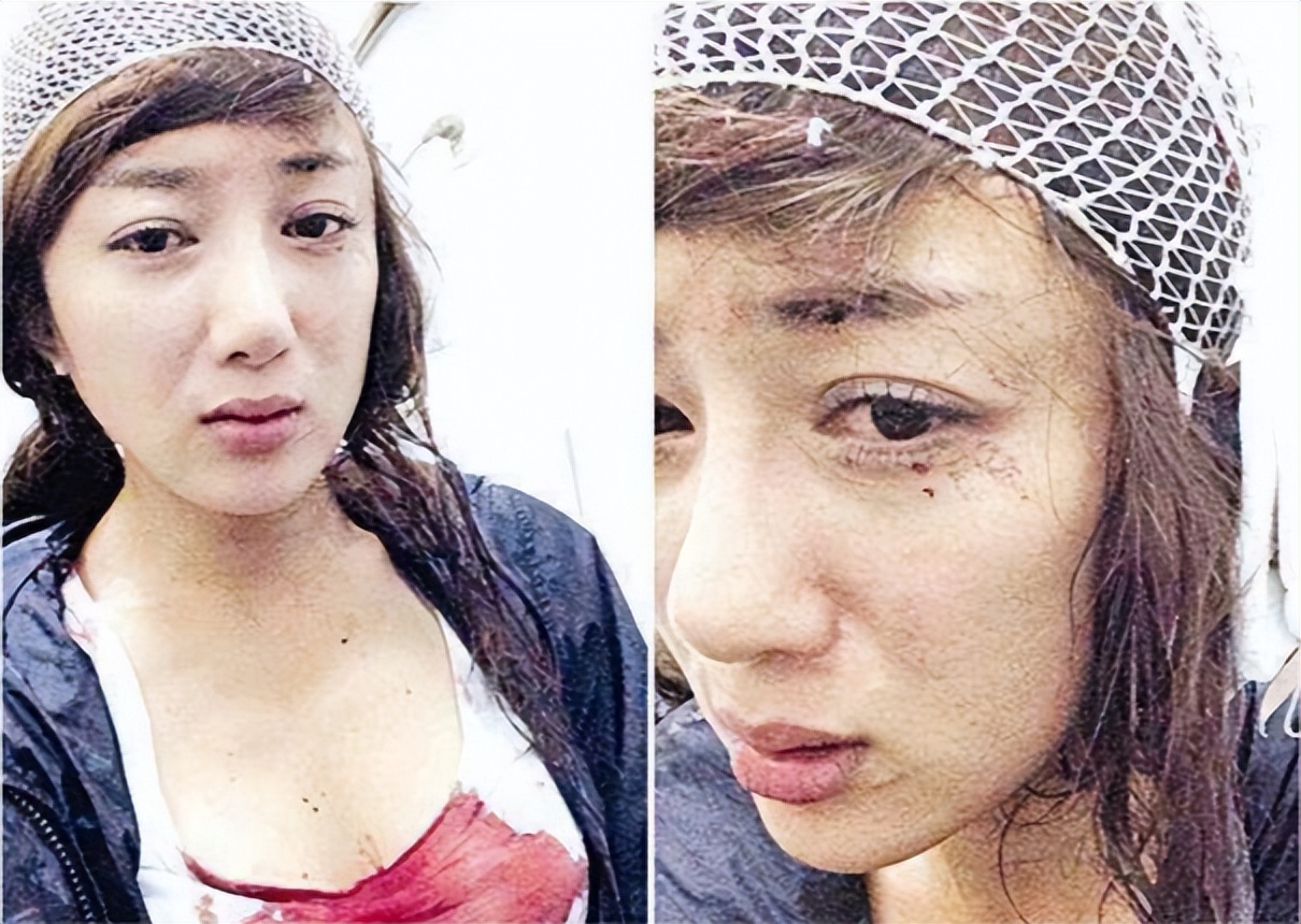 哪些明星整容后遗症越来越严重,整容明星后遗症对比图片