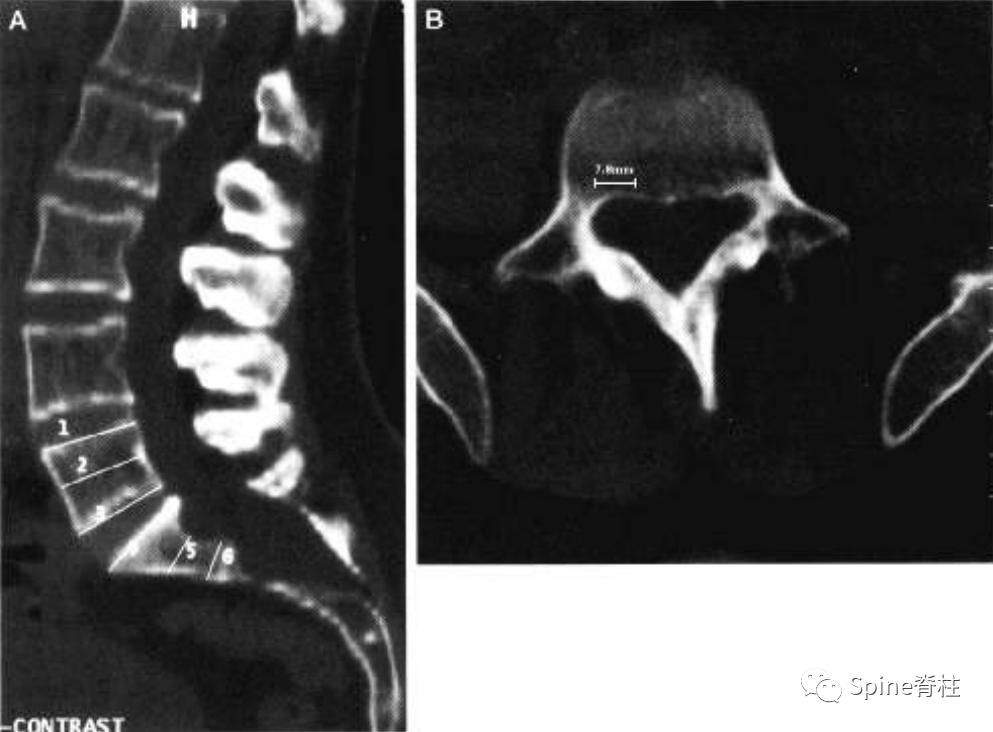 硬膜囊扩张是什么意思,硬膜囊扩张压迫神经
