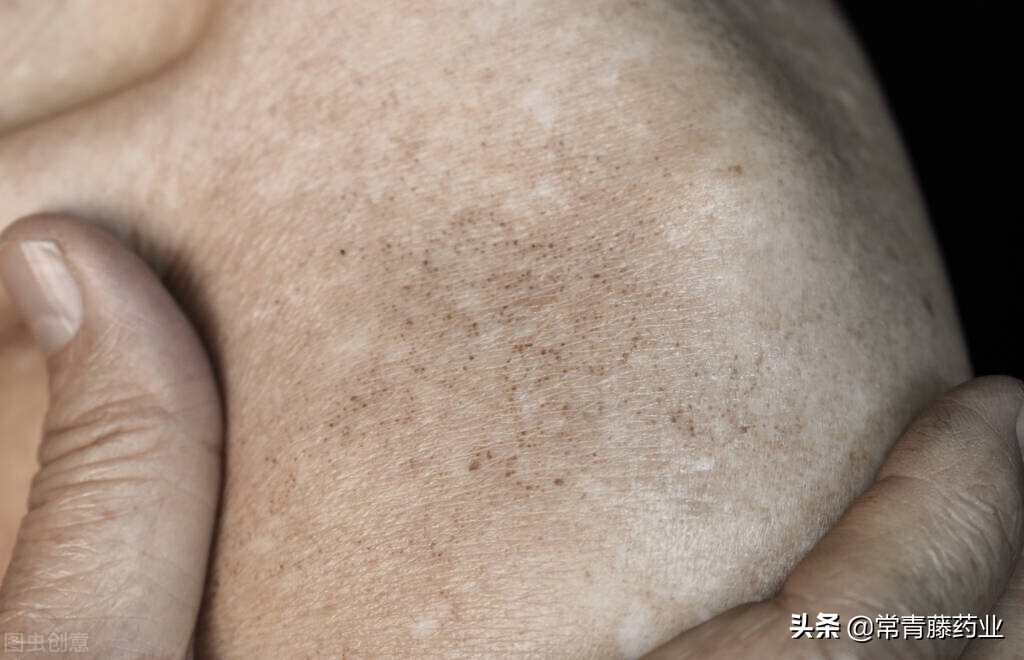 雀斑晒斑各种斑都是怎么形成的,色斑雀斑晒斑的区别