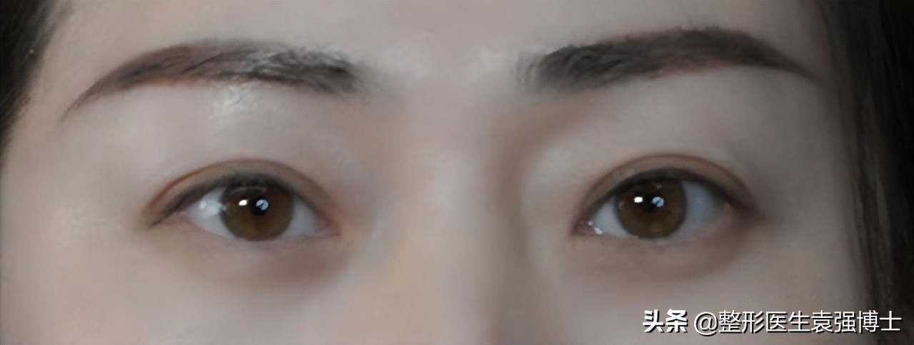 眼周年轻化手术效果可以持续多久,眼周医美项目