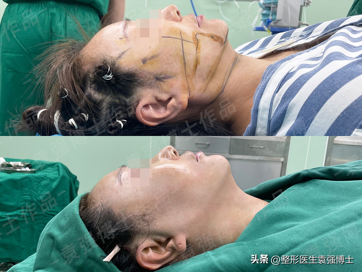 44岁女士拉皮除皱,50岁女人面部拉皮