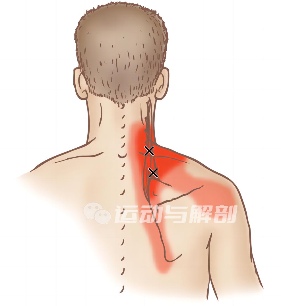 肩胛提肌这块肌肉经常被我们过度代偿,你有没有中过招?