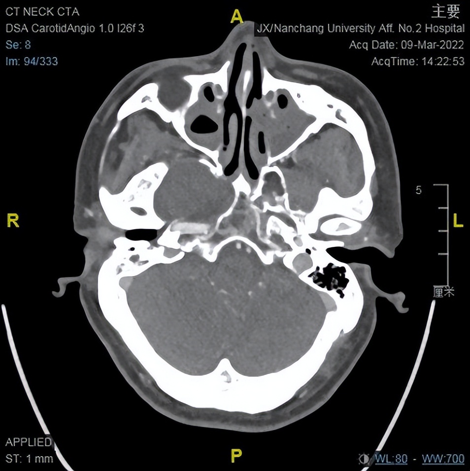 南昌二附院耳鼻喉科手术,南昌大学第二附属医院耳鼻咽喉科