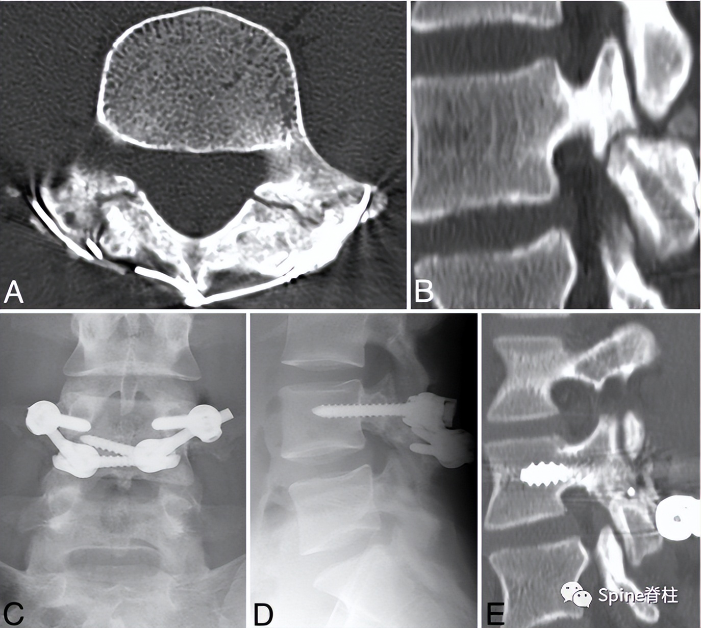 峡部裂和隐性峡部裂有区别吗,单纯峡部裂可以做峡部修复吗