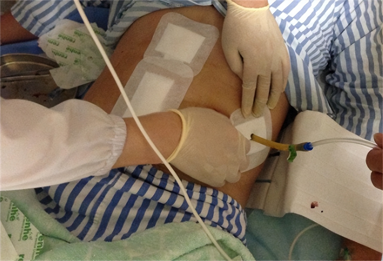 抗癌王伟怎么样了,患癌症练健美的王伟现在怎么样了