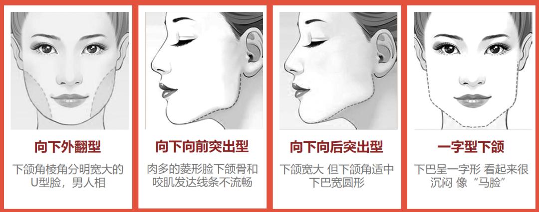 韦敏颧骨手术怎么样,九院下颌角