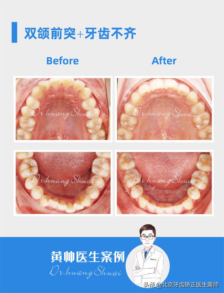 嘴凸的人怎么笑起来好看,嘴凸怎么让自己不焦虑