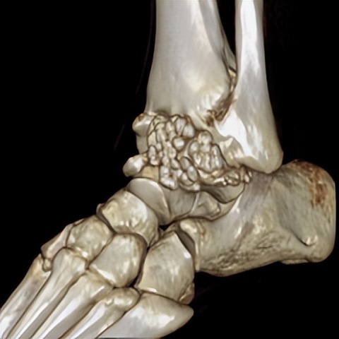 脚踝轻微扭伤如何处理,脚踝轻微扭伤用什么药物