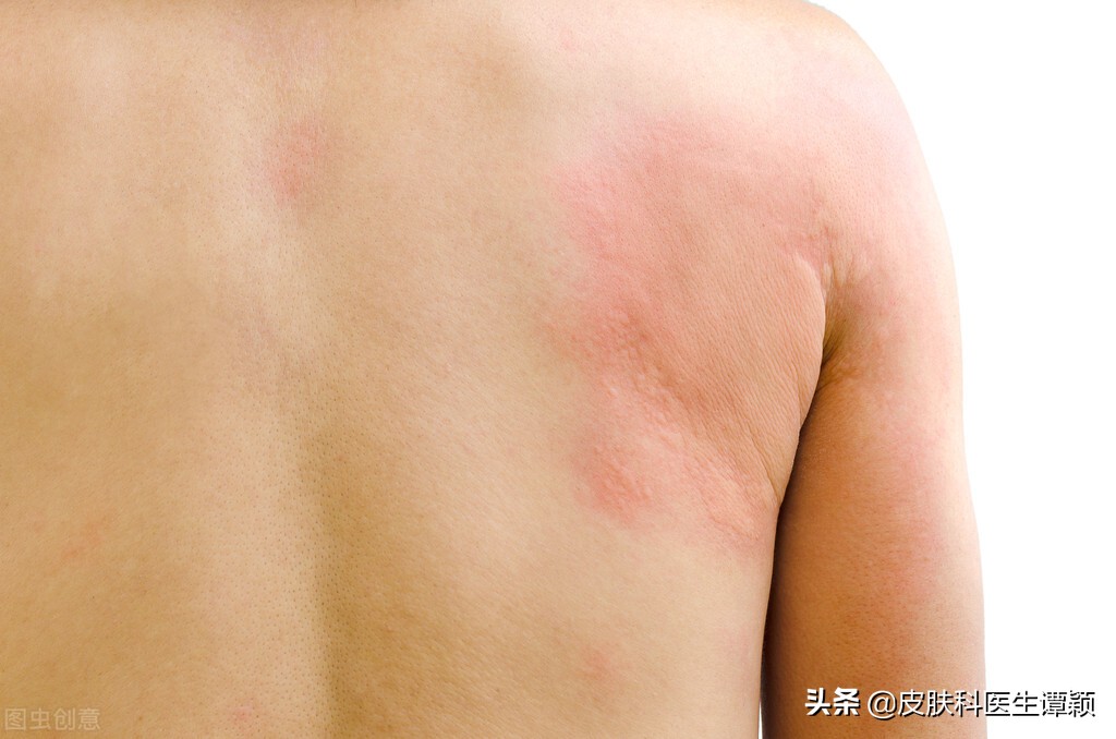 皮肤科热性荨麻疹,麻疹与荨麻疹的区别有哪些