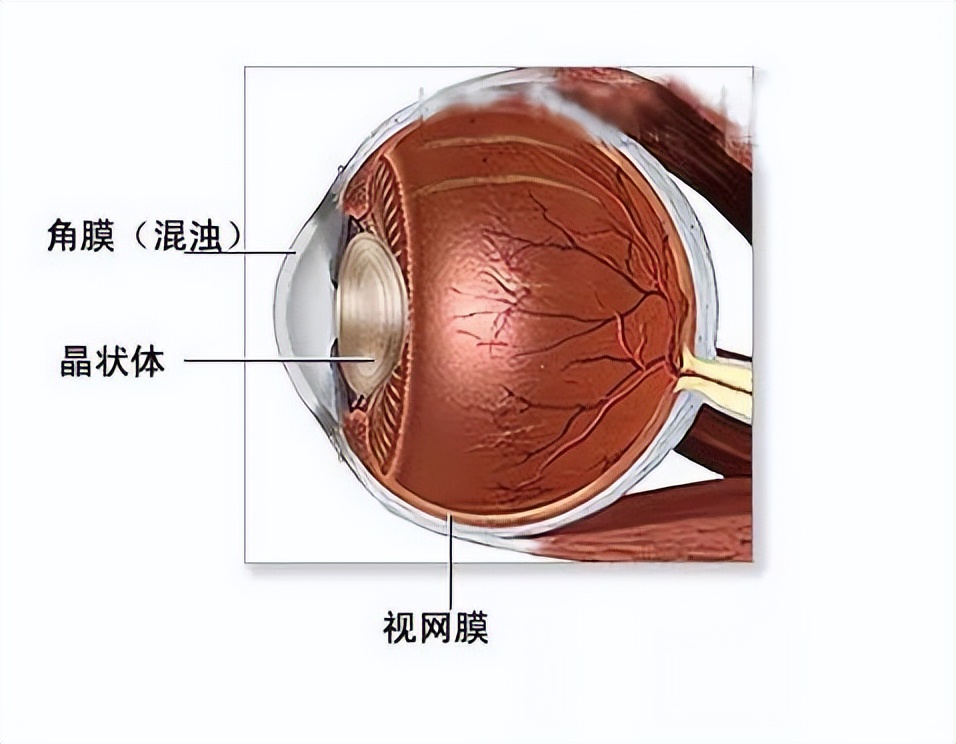 角膜病最好治疗方法,角膜病为什么难治