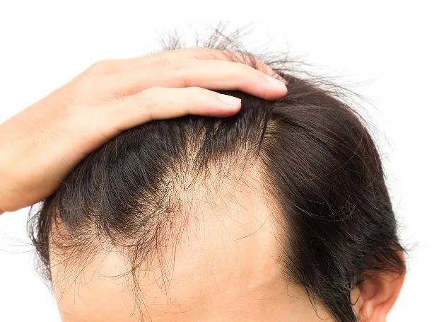 秃顶脱发治疗最快的方法,脱发比较严重怎么制止