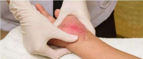 肝硬化代偿期手臂有小红点脂肪粒,肝硬化出现小红点可以自己消失吗