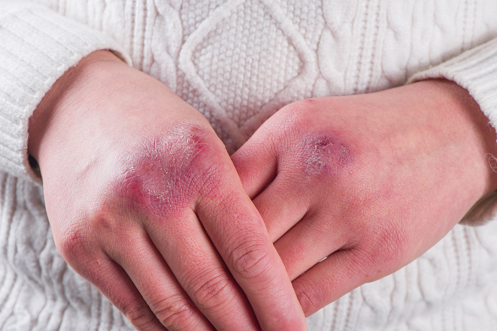 冻到了有什么症状,冻伤皮肤变红是快好了吗