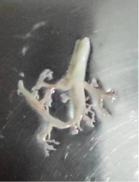 气管上长了一个疙瘩,气管里长了一个瘤