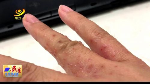 医生提醒：保持心情愉悦将有效避免患上汗疱疹