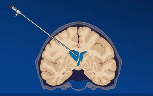 健康新区|十年磨一“镜”，锋走毫厘间——业达医院神外专家任志文