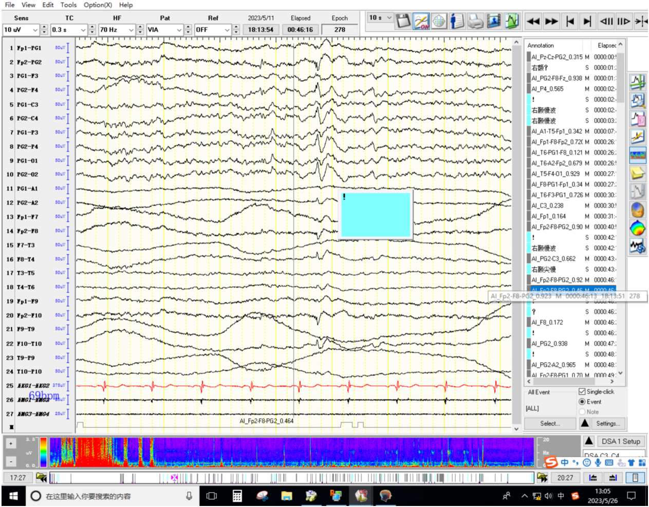 网易传媒携手北京协和医院共研国际首个多模态AI癫痫样放电检测系统