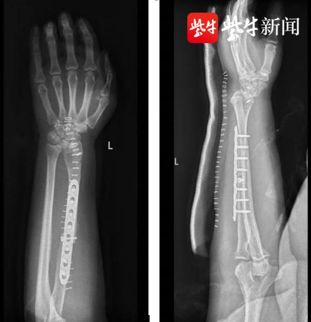 手腕长出“鸡蛋”大硬块，这是种爱“吃”骨头的罕见肿瘤