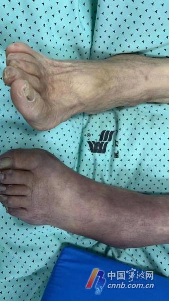 手臂皮肤突然发黑,手臂和小腿发黑怎么回事