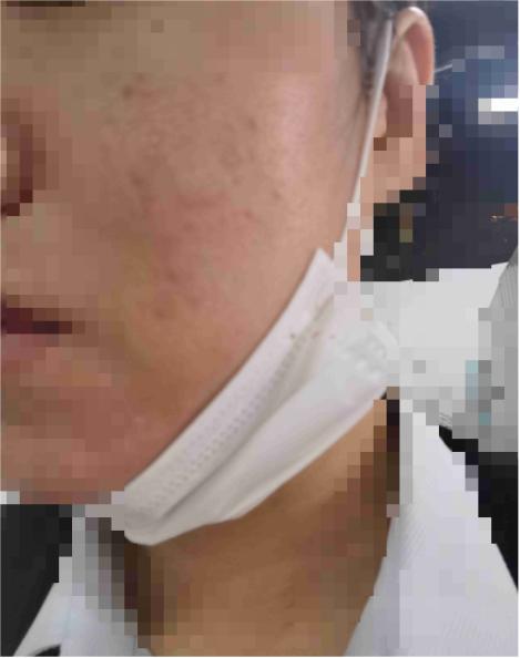 美容仪面部烧伤,脸上被美容仪烫伤了