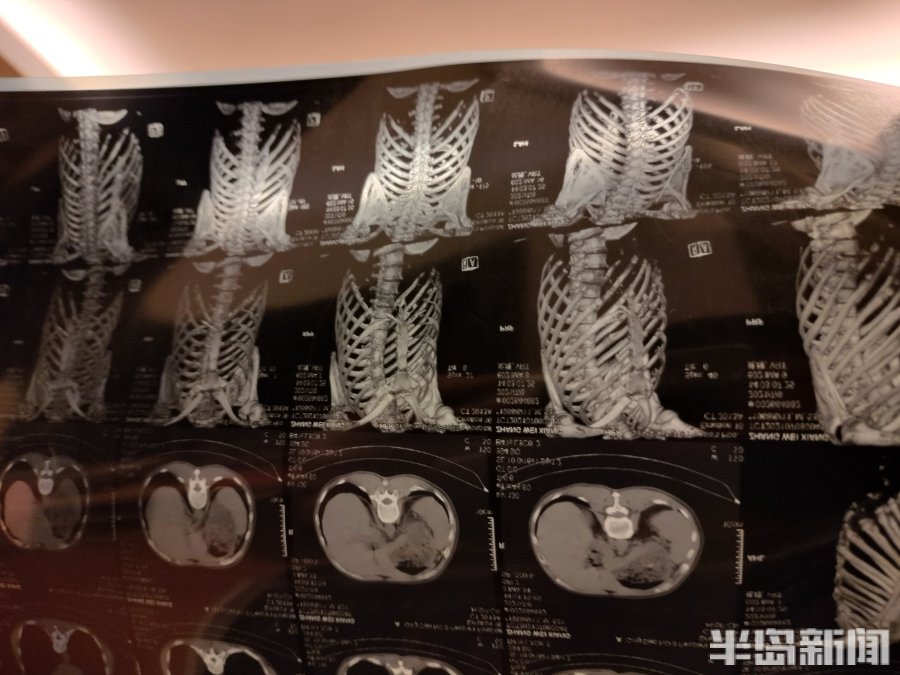 半岛调查丨又起波澜！小区物业经理与业主肢体冲突，致对方三根肋骨骨折，一审获刑八个月