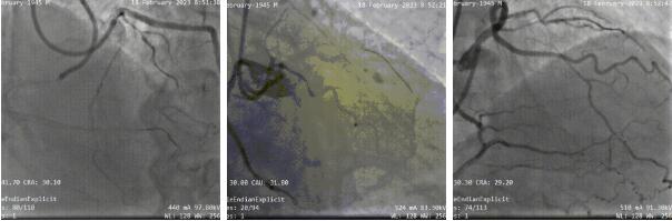 3DF打印助力温州医科大温州医科大学附属第一医院周浩团队完成一例复杂高危的冠脉CTO手术