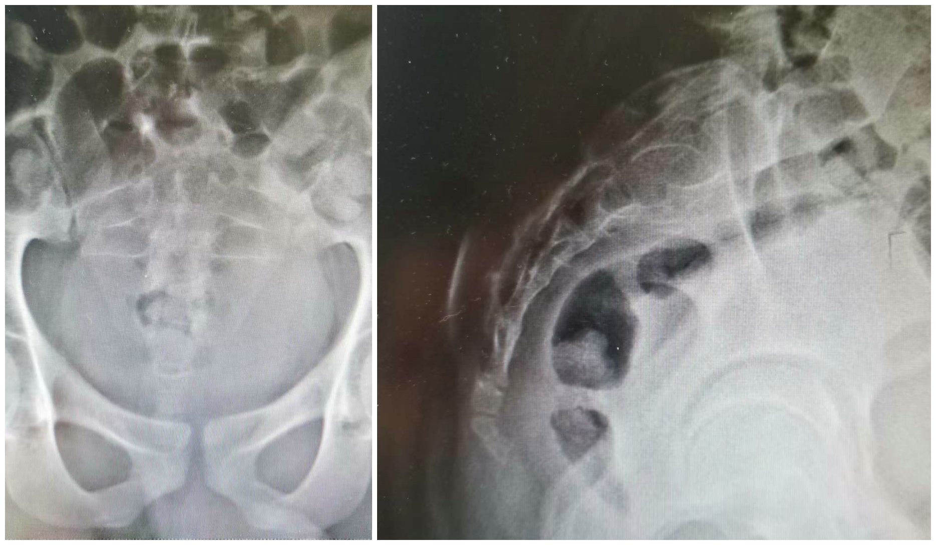 兰大二院腰椎间盘突出微创手术,兰大二院微创介入治疗