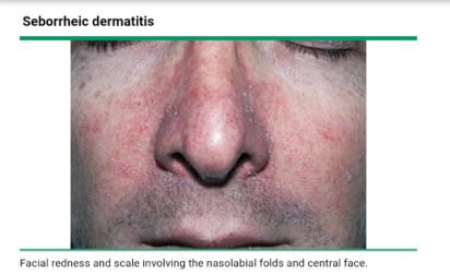 红斑狼疮皮疹的鉴别诊断,系统性红斑狼疮脸上的红斑图片