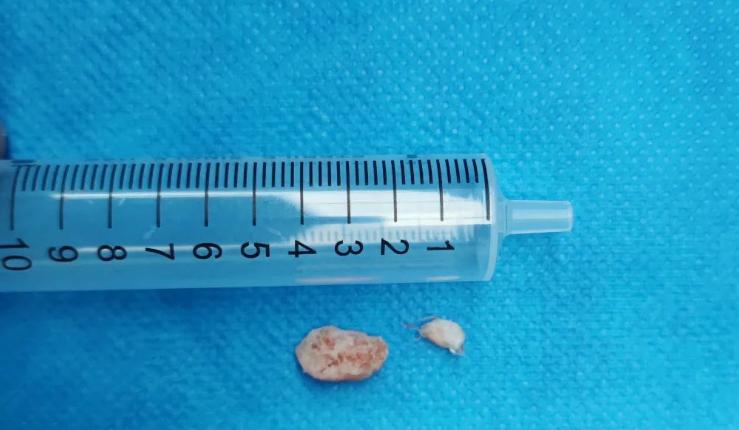 烟台山医院微创手术流程,烟台山医院做膝盖关节手术