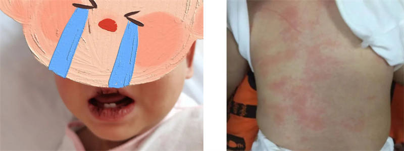 宝宝反复高烧6天不退是川崎病吗,孩子高烧不退当心得了川崎病