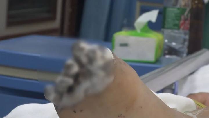 女孩给iphone充电遭电击致内脏受损,女孩充电时玩手机被电击面临截肢