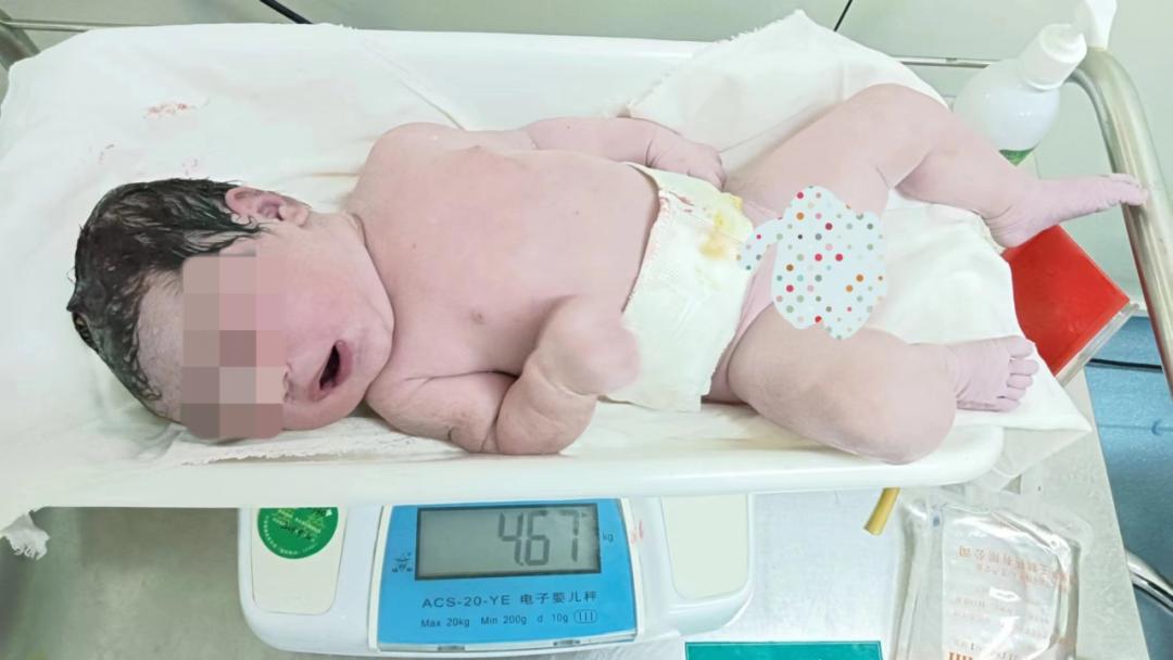 9斤4两，寿光综合医院产房经阴分娩一例4670g巨大儿