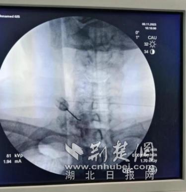 老人胳膊长泡疼到夜不能寐“罪魁祸首”竟是带状疱疹