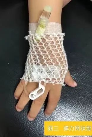 婴幼儿留置针固定最好的方法,如何能快速固定新生儿留置针